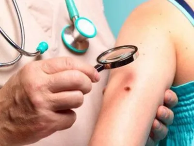 В Кременчуге показатели заболевания меланомой кожи "опережают" рак легких и рак желудка