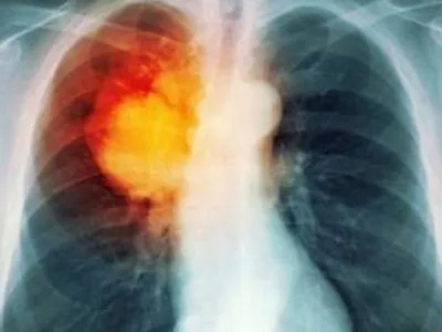 В Полтавской области каждый второй случай рака легких фиксируют на запущенной стадии