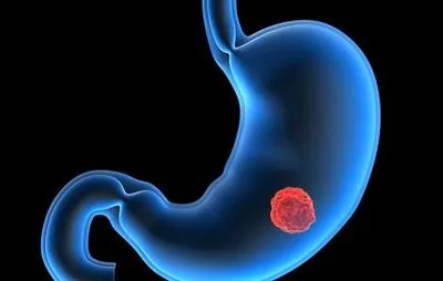 Кількість захворювань на рак шлунка на Сумщині за рік зросла на 9,1%