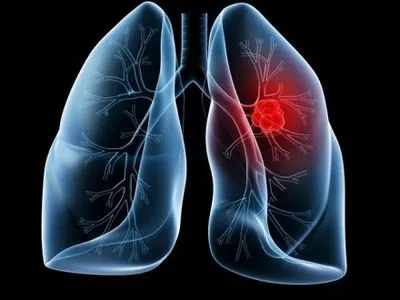 Лікар: рак легенів – одна із найагресивніших форм онкології