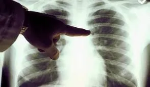 В Україні кожен п'ятий хворий на рак легенів дізнається про хворобу під час профілактичних оглядів