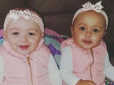 Девушки-близнецы в США родились с разным цветом кожи