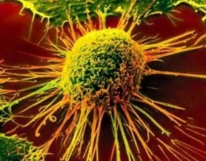 За последние 15 лет ни одна национальная программа борьбы с онкологией не была выполнена - онкологи