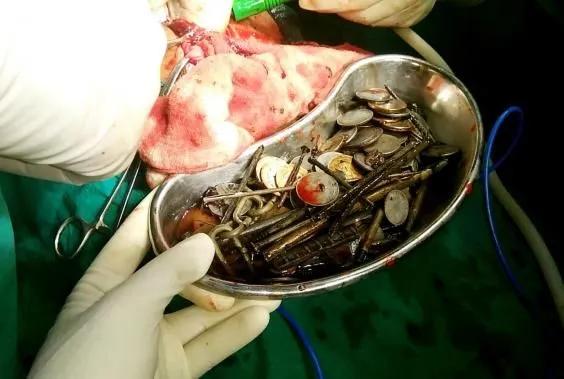 Хирурги в Индии извлекли из пациента 7 кг железа