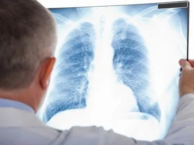 Україна опинилася у топ-5 антирейтингу щодо туберкульозу