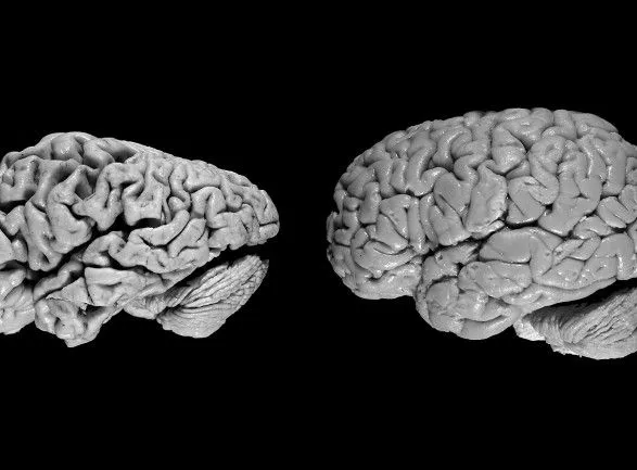 Нейромережа навчилася визначати хворобу Альцгеймера раніше за лікарів