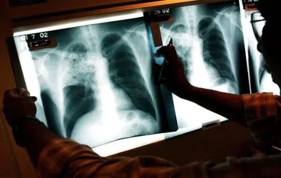 У грудні минулого року зареєстровано понад 2 тисяч випадків туберкульозу