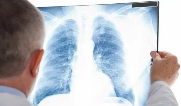 В Україні щодня помирають 10 хворих на туберкульоз