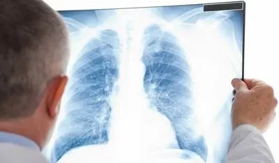 В Україні щодня помирають 10 хворих на туберкульоз