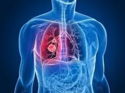 Кіровоградщина займає друге місце в країні за рівнем захворюваності на туберкульоз