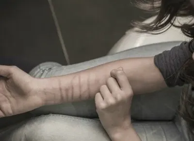 Школьница изрезала руку лезвием из-за интернет-игры