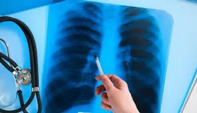 В прошлом году в Украине выявили более 26 тыс. случаев заболевания туберкулезом