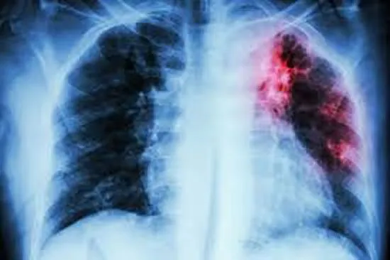 В Україні понад 400 дітей хворіють на туберкульоз