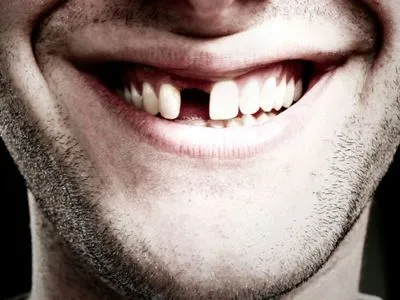 Можливе ускладнення: у перехворілих на COVID-19 випадають зуби