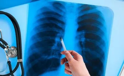 В Україні за місяць виявили понад 1,2 тисячі випадків туберкульозу