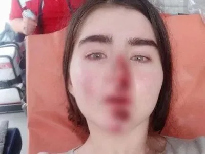 В Киеве девушка разбила лицо из-за неисправного самоката