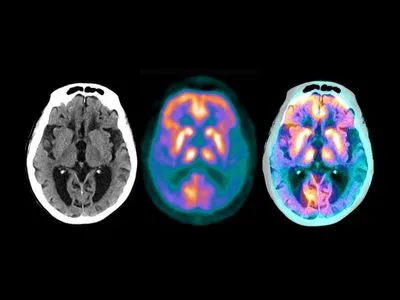 Исследование: COVID-19 может привести к деменции, подобной болезни Альцгеймера