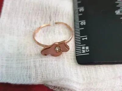 У Львові однорічна дівчинка проковтнула перстень із гострими краями: його діставали дві години