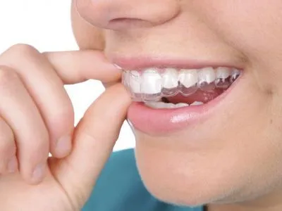 Элайнеры на зубы: особенности и отличия от брекетов
