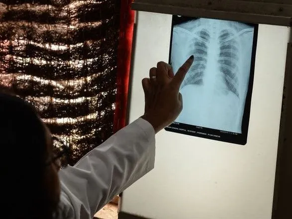 ВООЗ: смертність від туберкульозу в світі виросла вперше за десятиліття