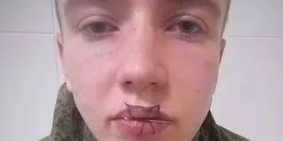В России солдат срочной службы после ссоры с девушкой зашил себе рот