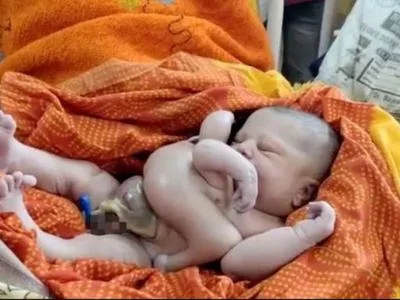 В Індії народилася дитина з 4 руками та 4 ногами