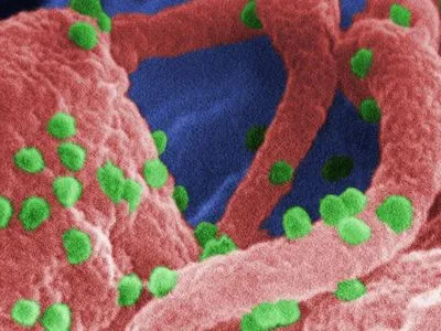 Перша жінка "вилікувалася" від ВІЛ завдяки стовбуровим клітинам - вчені