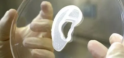 Лікарі пересадили вухо з клітин людини, зроблене за допомогою 3D-принтера