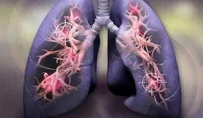 Таблетки від раку легенів знижують ризик смерті вдвічі - дослідження