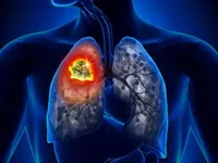 Сьогодні Всесвітній день боротьби із раком легень – яка ситуація із цією хворобою в Україні