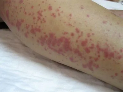 Лептоспироз на Черниговщине: инфекционная болезнь выявлена у 12 человек, среди них двое детей