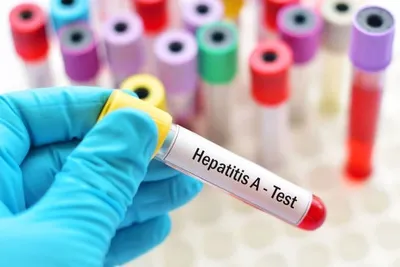 Hepatitis A outbreak in Vinnytsia region: the likely source of infection was found at the local market – Kuzin
