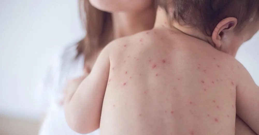 55 cases of measles have been recorded in Ukraine since the beginning of the year