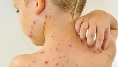 Last year, the number of measles cases increased sixfold in Ukraine