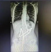 Ukrainian doctors save child who swallowed 20 magnets
