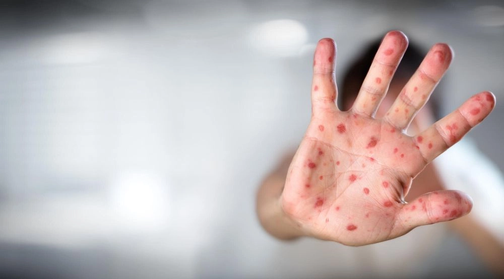 The number of people infected with chickenpox has increased in Poltava region: 188 people were diagnosed with it in a week
