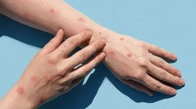 Monkeypox outbreak detected in Germany